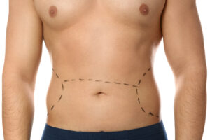 a man's stomach with lines drawn on it