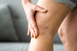 a person holding a leg with a varicose veins